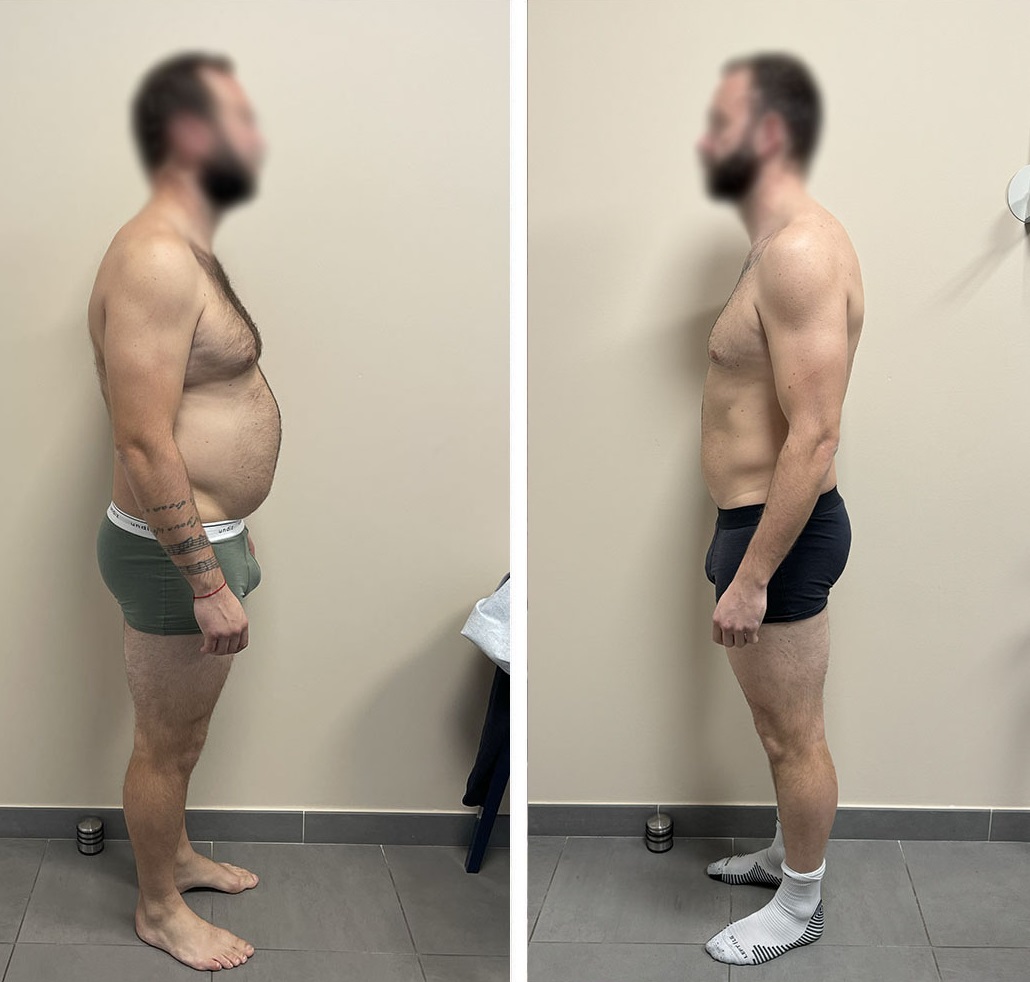 Laurent M. : -35 Kilos avec Mounjaro - De 120kg à 85kg en 10 Mois